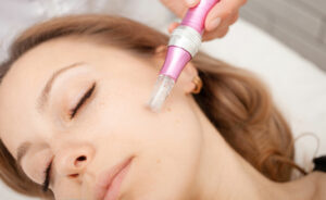 microneedling procedure