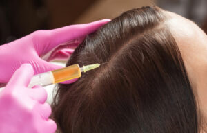 prp for hair treatment