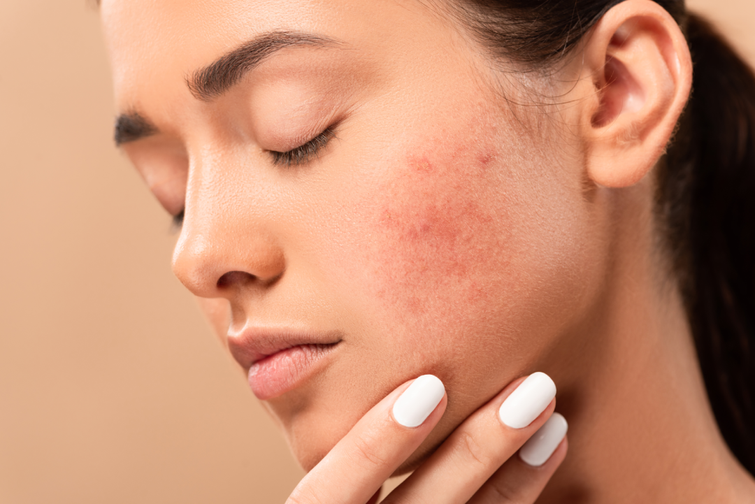 Close-up of acne-prone skin prepared for GLIMPSE skin analysis.