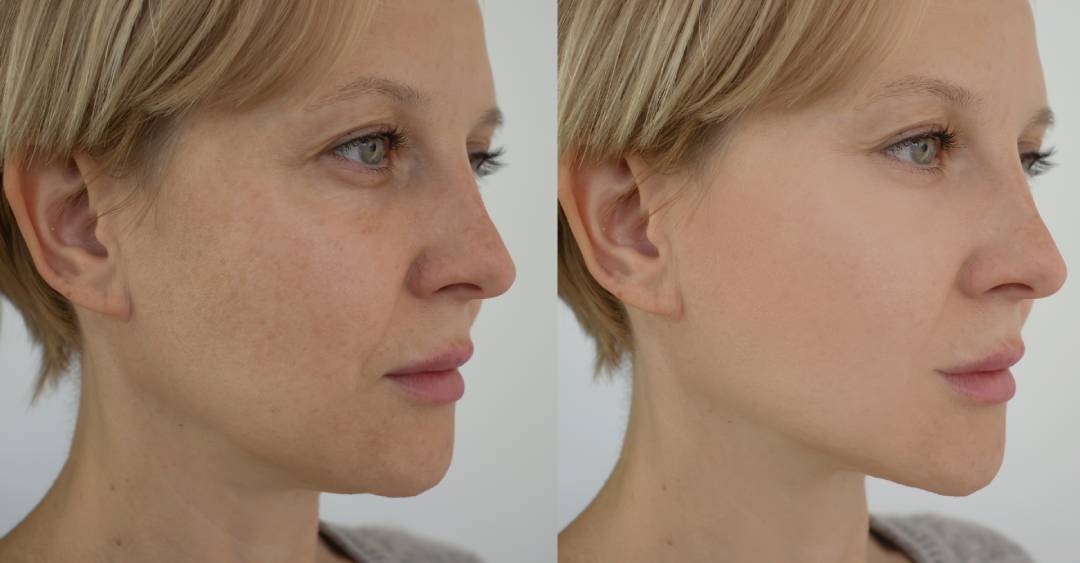 Before and after comparison showcasing skin rejuvenation with Restylane.