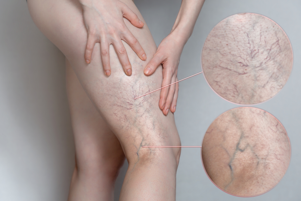 Leg veins highlighted for analysis using GLIMPSE diagnostic technology