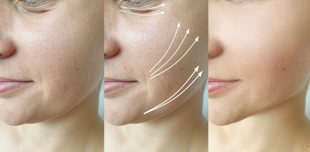 Visible skin improvements after CO2 laser therapy treatment.