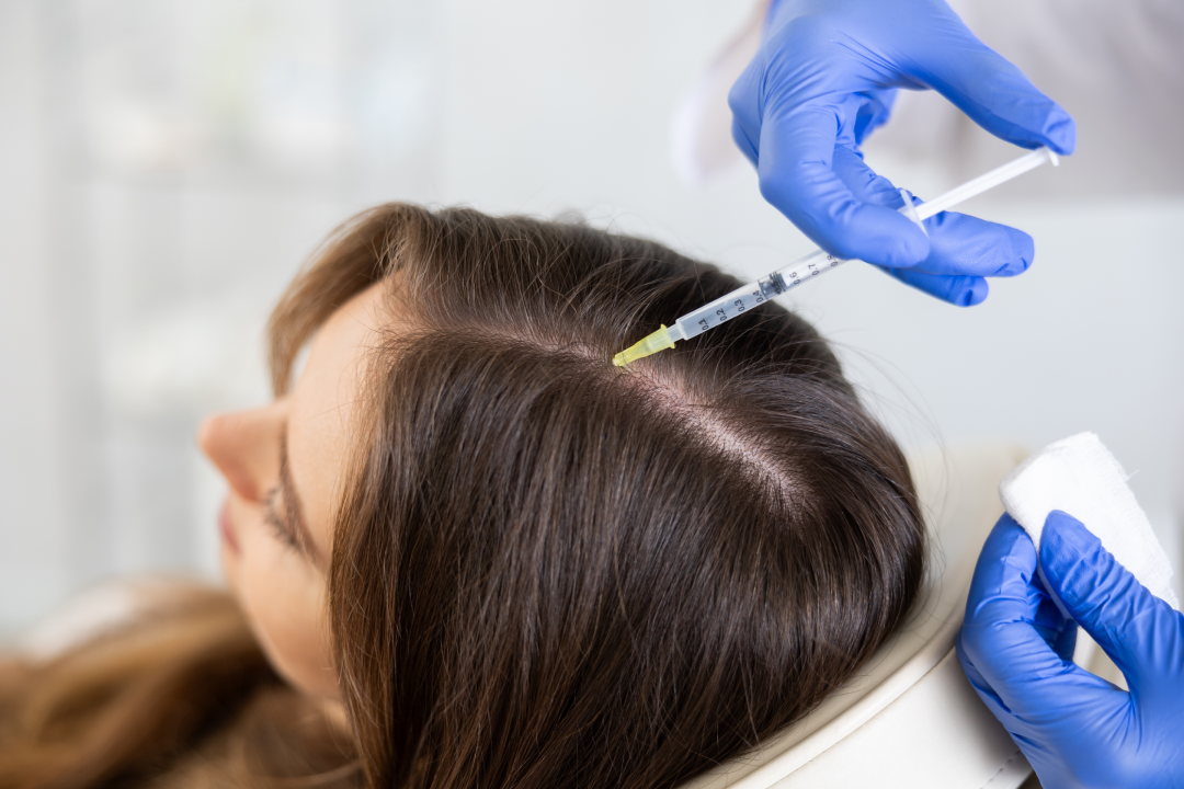 A woman receiving a PRP hair restoration injection for thicker and healthier hair.