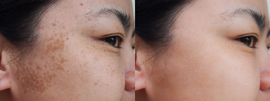 Before and after results of CO2 laser therapy on sun-damaged skin.