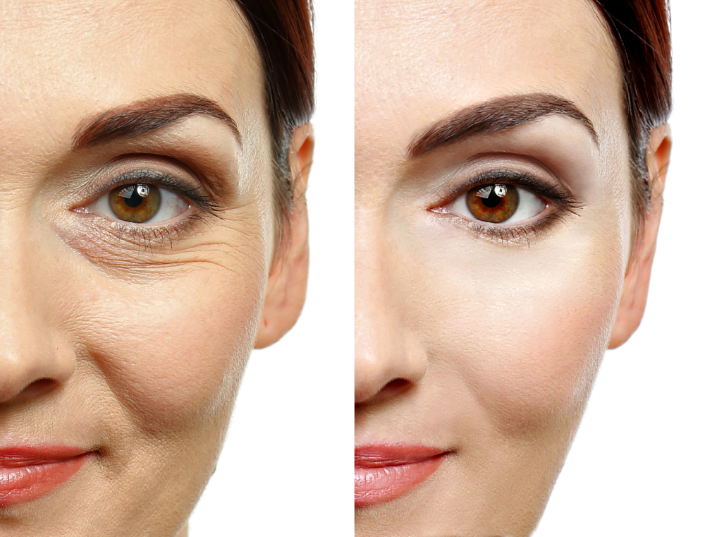 Before and after image showing eye wrinkles smoothed by Letybo treatment.